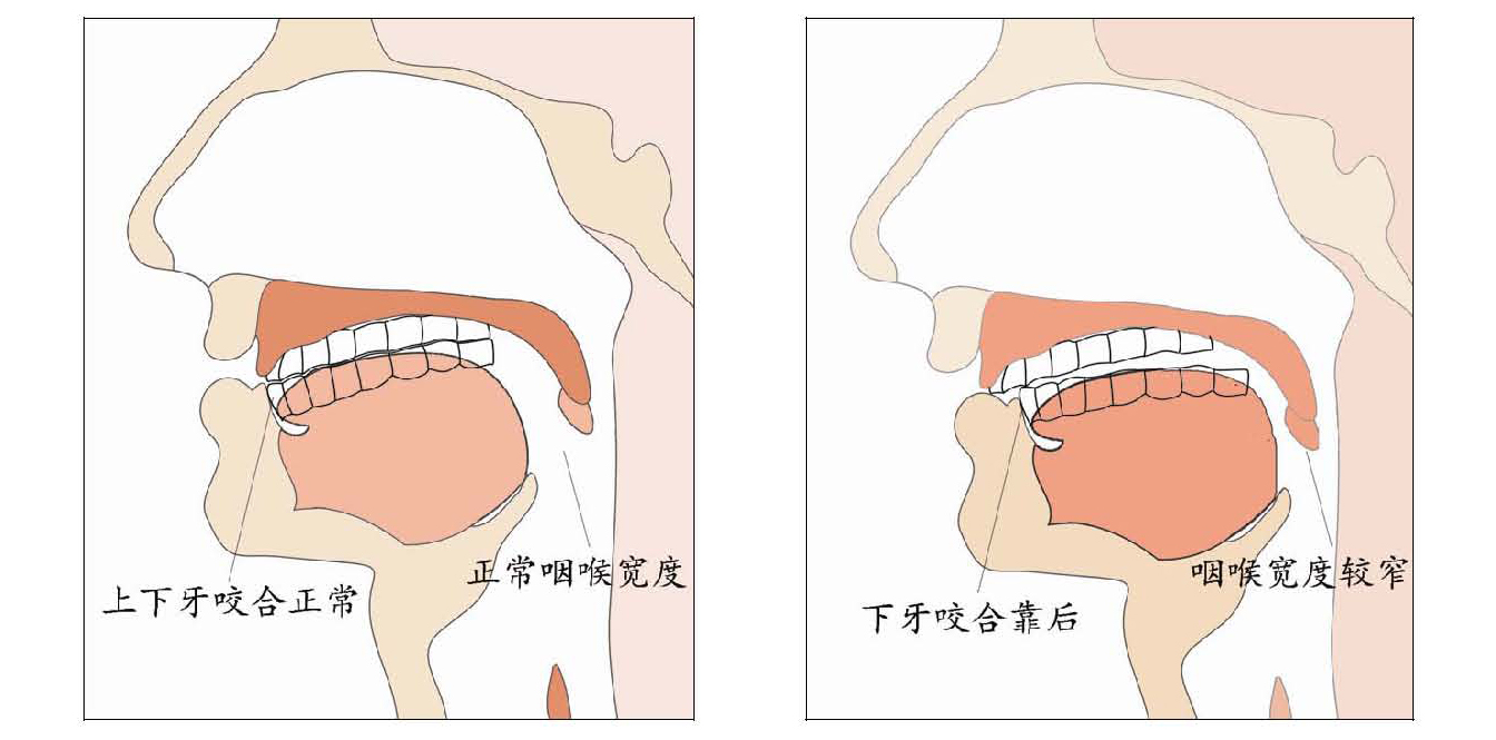 睡觉打呼噜的分析图.jpg