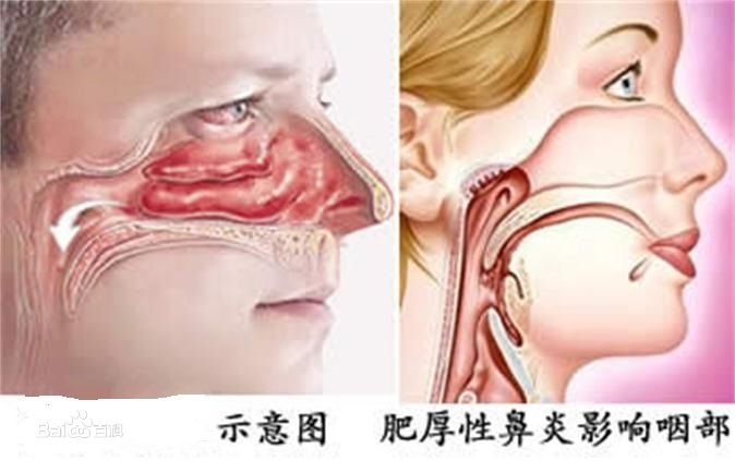 你知道鼻甲肥大的重要性吗?