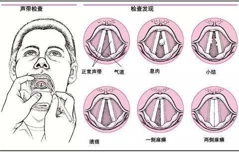 手术治疗声带息肉可治好